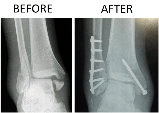 Ankle Surgery