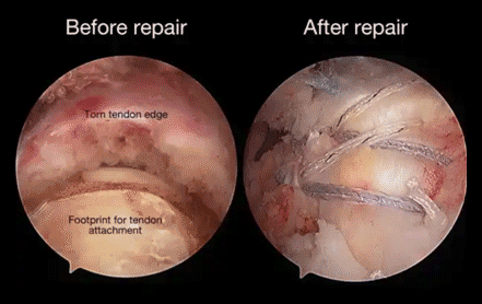 Rotator Cuff Surgery