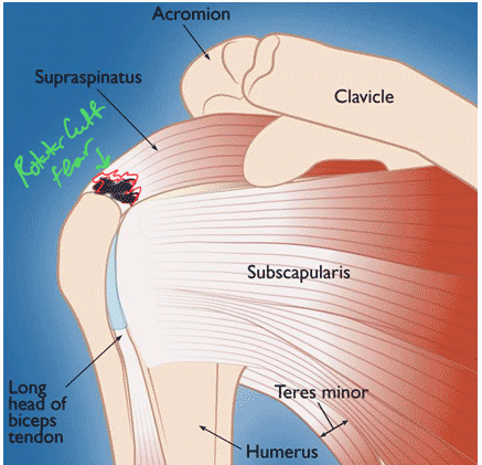 Rotator Cuff Tear